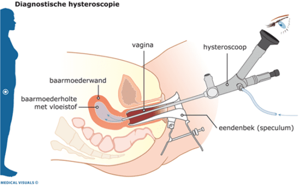 652x0_mk_diagnostische_hysteroscopie.png
