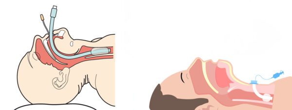 Beademing op de IC | HMC