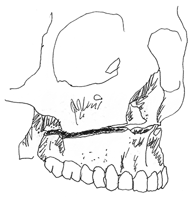 chirurgische_kaakcorrectie_image3.png