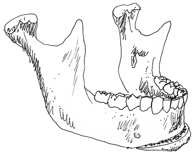 chirurgische_kaakcorrectie_image4.png