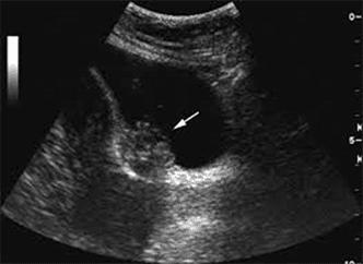 echo_endometriose.png