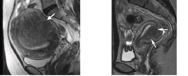 endometriose_mri.png