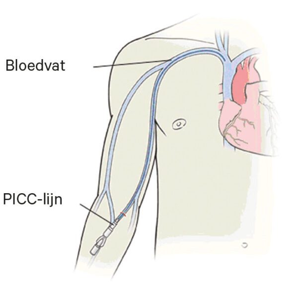 Ziektebeeld Angiografie Plaatsing Van Een PICC HMC Ziektebeeld Angiografie Plaatsing Van Een PICC HMC