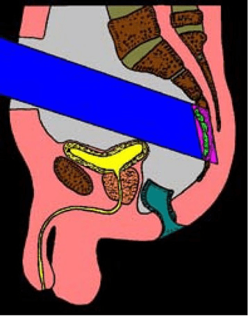 bestralingsbuis