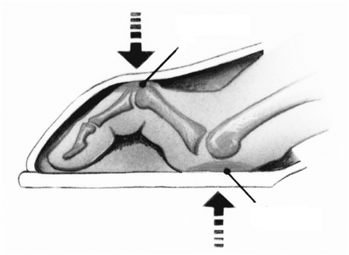 hamerteencorrectie_fig1.png