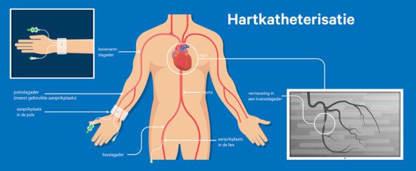 hartkatherisatie1136px.jpg