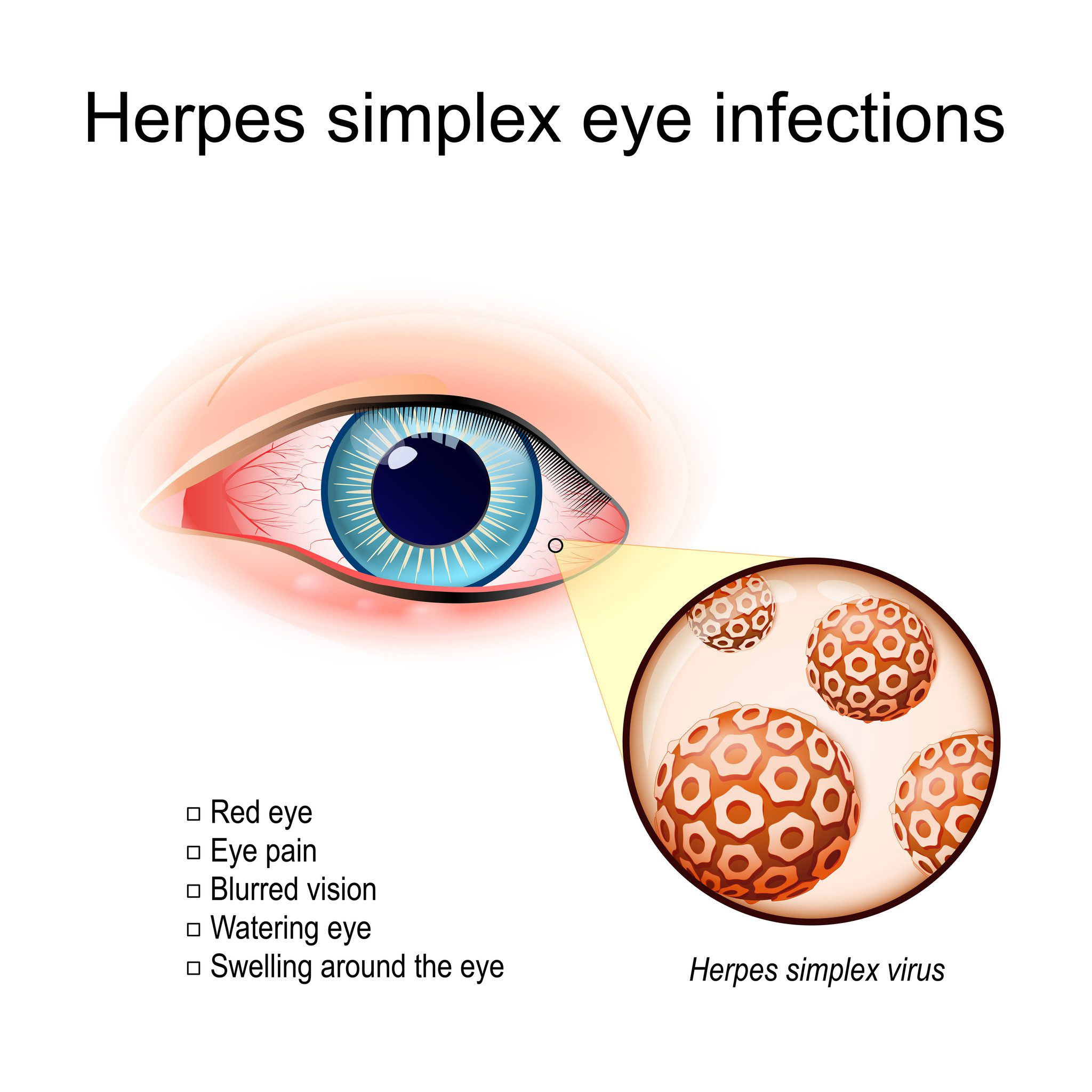 Herpes simplex
