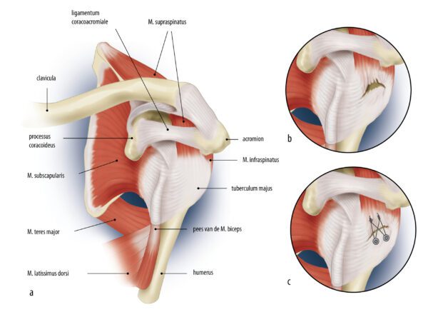 kijkoperatie aan de schouder rotator cuff a3163 f1 bewerkt2