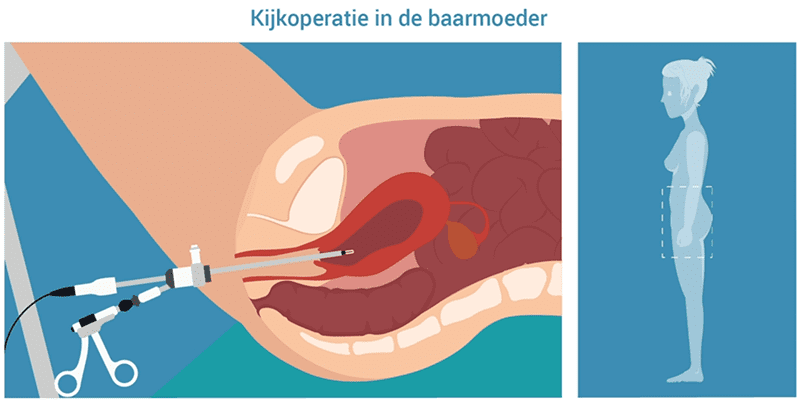 Kijkoperatie in de baarmoeder