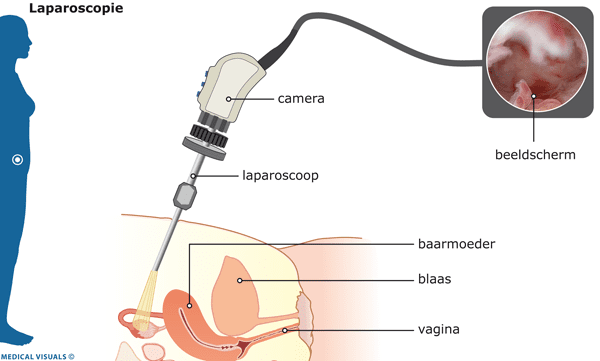 kijkoperatie laparoscopie endometriose