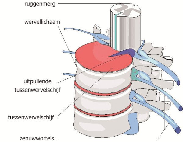 nekhernia