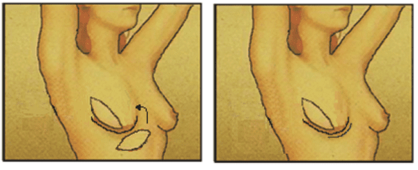 oncoplastische_reconstructie_aicap_lap.png