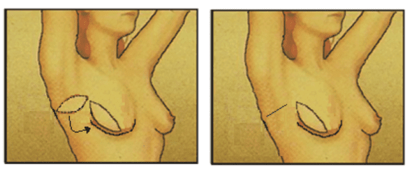 oncoplastische_reconstructie_licap_lap.png