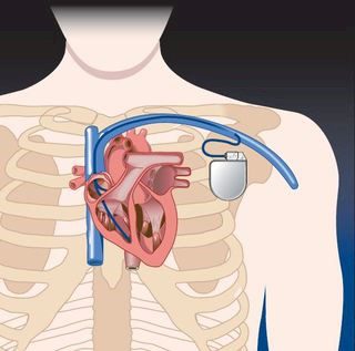 pacemaker_fig01.jpg