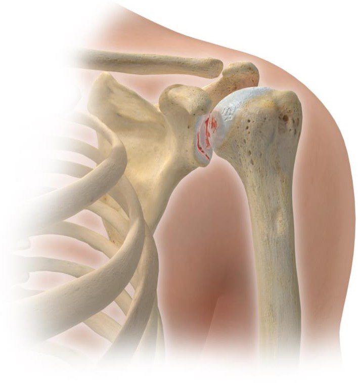 schouderprothese1