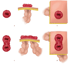 2 typen stoma's