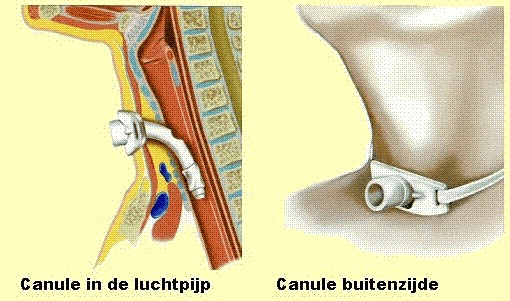 Illustratie canule