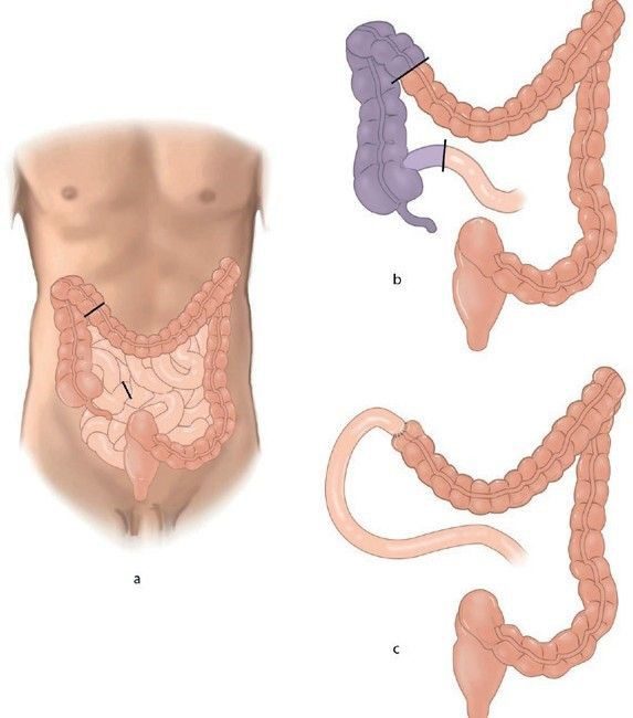 hemicolectomie_rechts