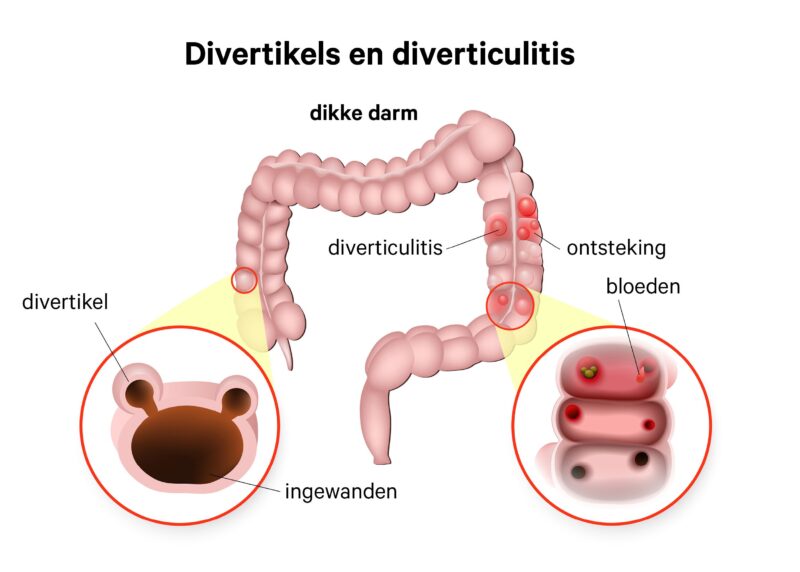 Divertikels en diverticulitis dikke darm