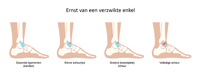 Ernst van een verzwikte enkel