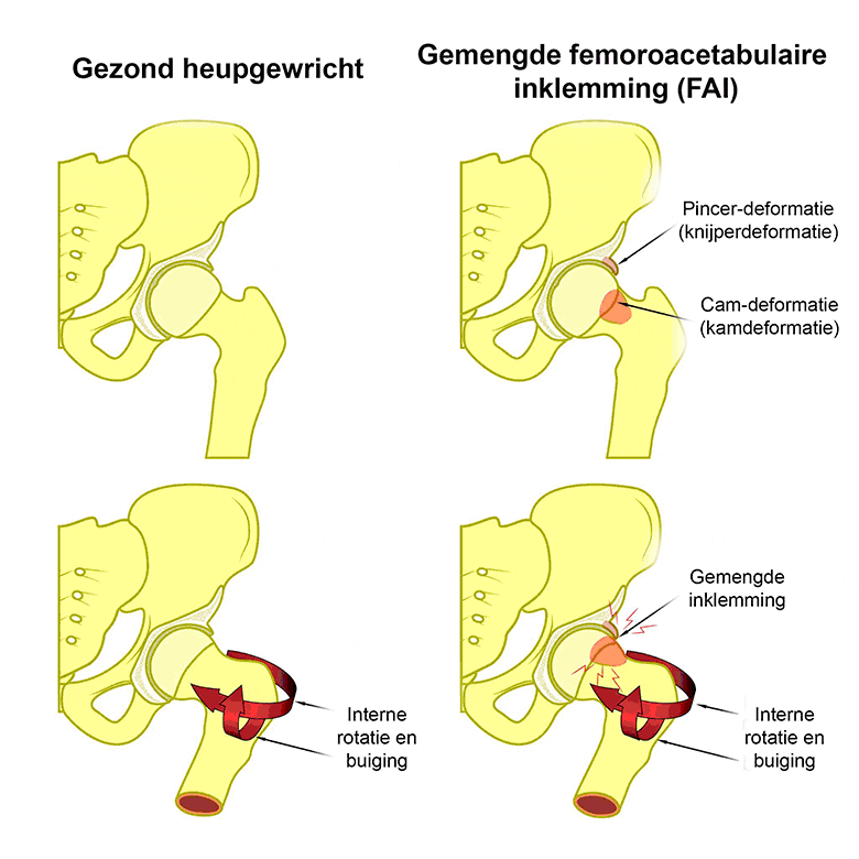 Heupgewricht