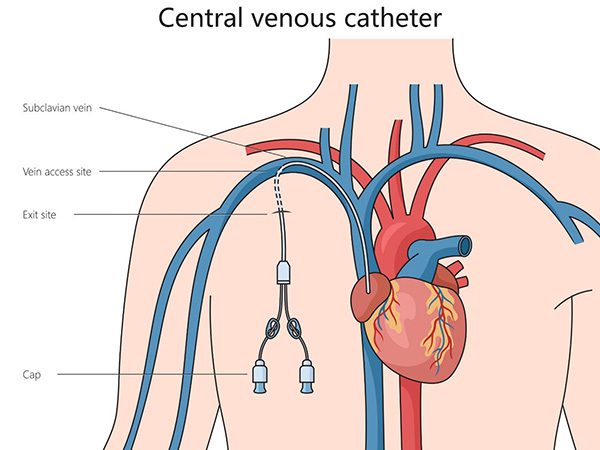 Centraal Veneuze Catheter (CVC)
