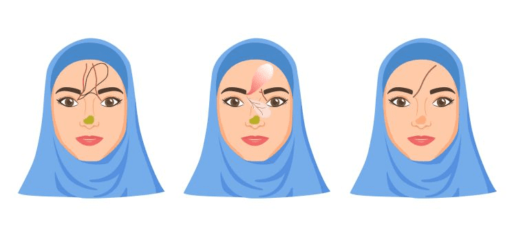 Neusreconstructie met huid van het voorhoofd (voorhoofdslap)