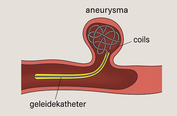 aneurysma coiling
