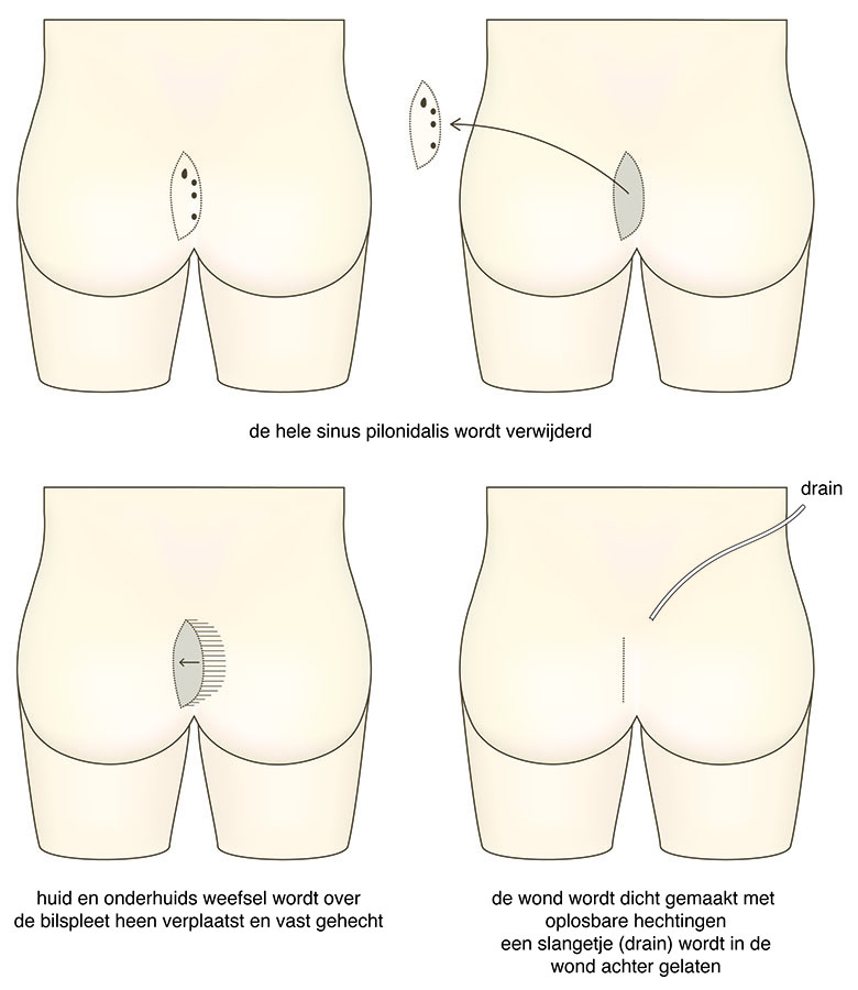 Cleft lift