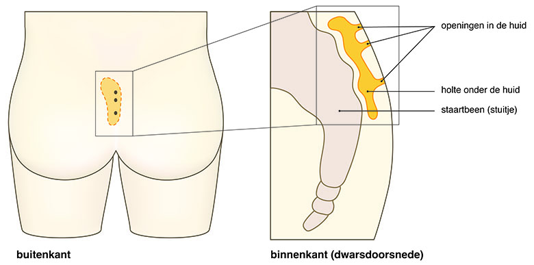 sinus pilonidalis (haarnestcyste)