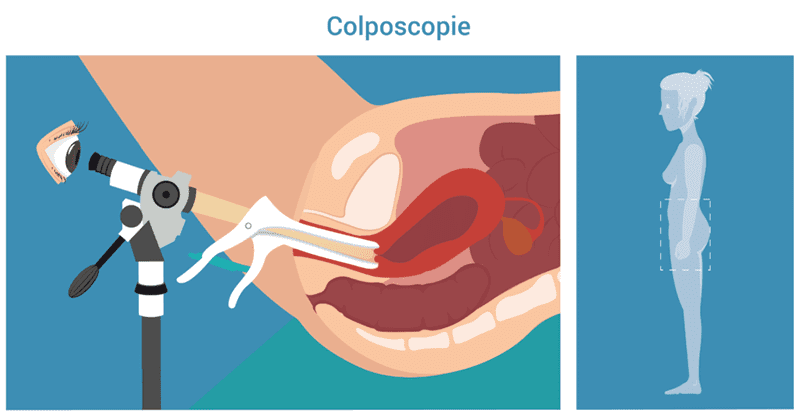 Colposcopie