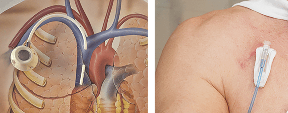 PAC: afbeelding links Het systeem bestaat uit een klein kastje met een slangetje eraan. Afbeelding rechts: de verpleegkundige neemt bloed af of sluit een infuus (slangetje) aan.
