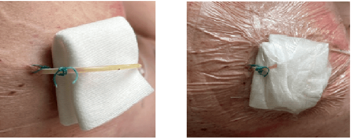 Portex drain: steriel gaasje(links) folie (rechts)