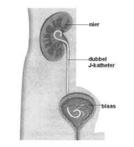 Nier, dubbel J-katheter, blaas