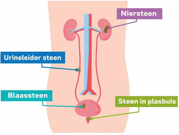 niersteen, urineleider steen, blaassteen, steen in plasbuis