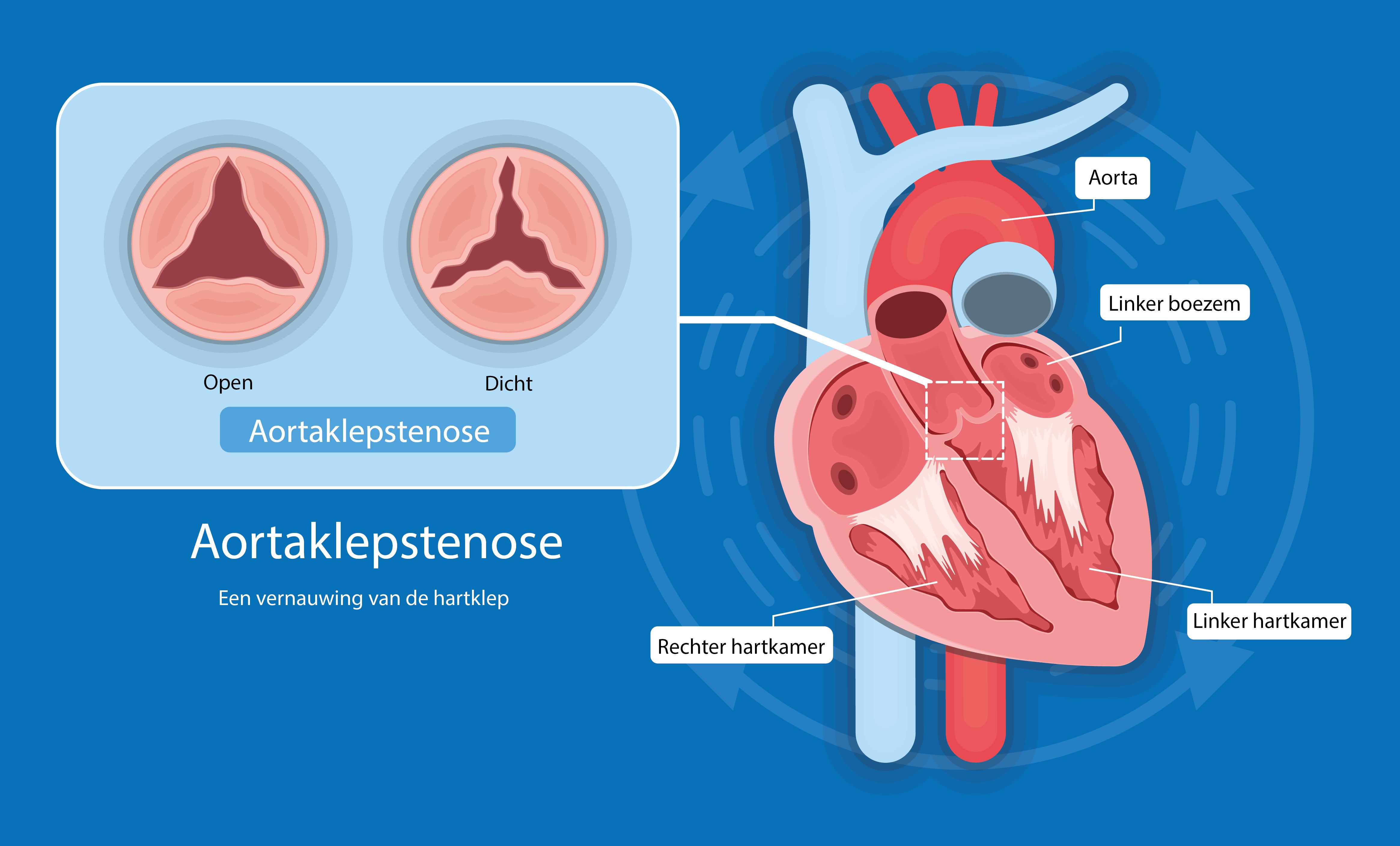 Aortaklepstenose | HMC
