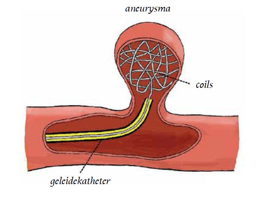 Aneurysma In Het Hoofd Symptomen